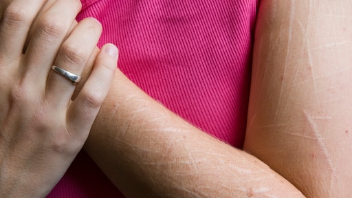 'Kwart Nederlandse jongeren verwondt zichzelf'