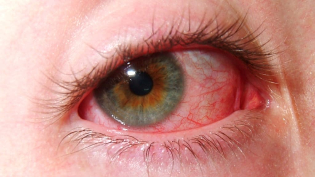 Vrouw kan ogen niet meer sluiten na mislukte operatie