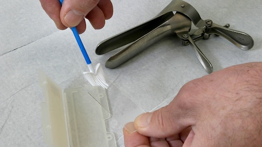 'Zelftest baarmoederhalskanker is net zo nauwkeurig als uitstrijkje'