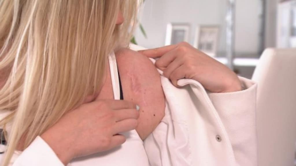 Antoni van Leeuwenhoekziekenhuis zet herpes in als middel tegen huidkanker