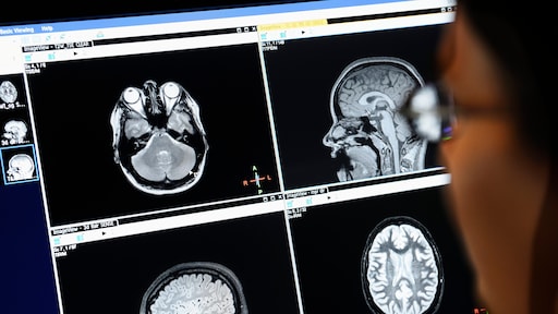 Eerste alzheimerbehandeling goedgekeurd voor Europa: 'Wetenschappelijke doorbraak'