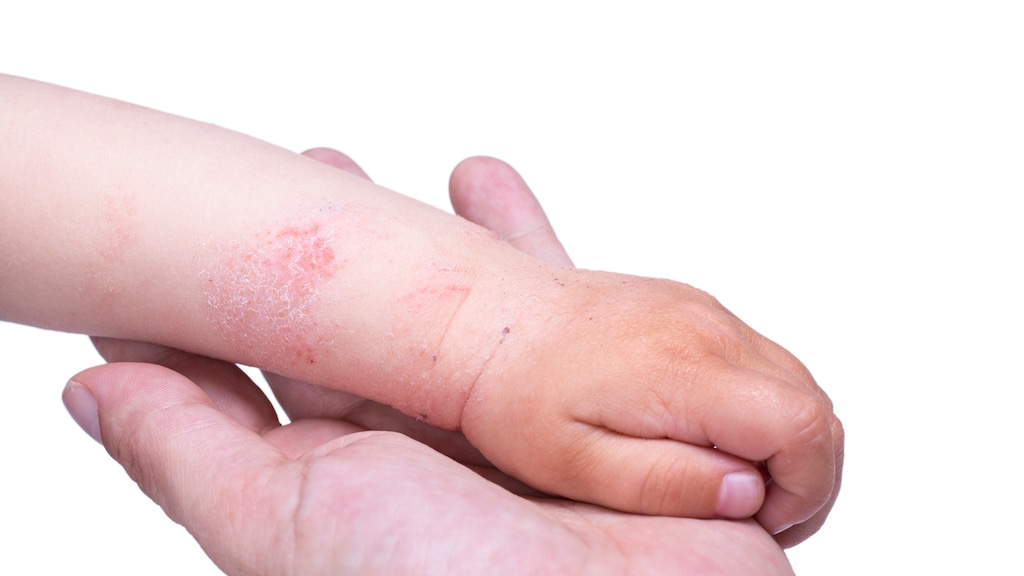 Roman (3) heeft ernstig eczeem: 'Ouders trekken hun kind bij hem vandaan'