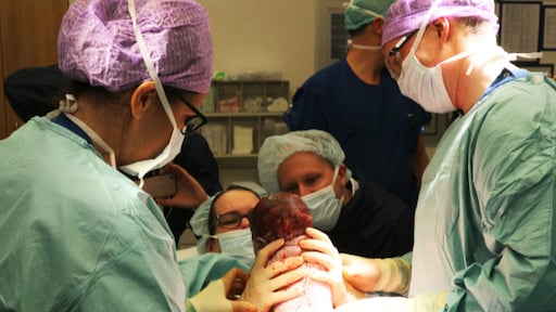 Primeur in Nederland: moeder tilt zelf dochtertje uit haar buik tijdens keizersnede