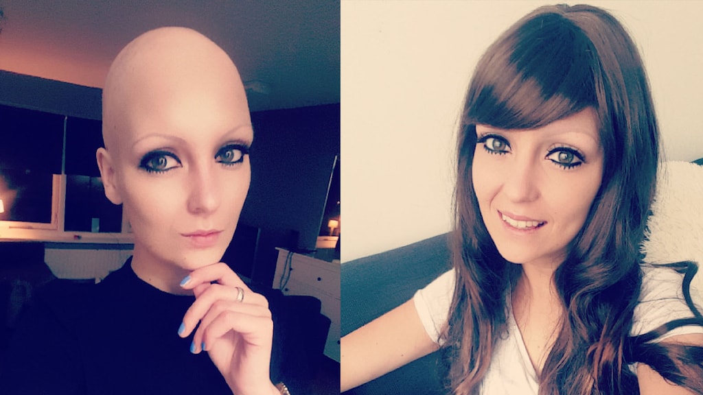 Weg hoofdhaar, wimpers en wenkbrauwen: 'Binnen drie weken was ik kaal'