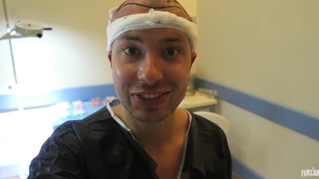 Haartransplantatie voor Youtuber Rutger Vink