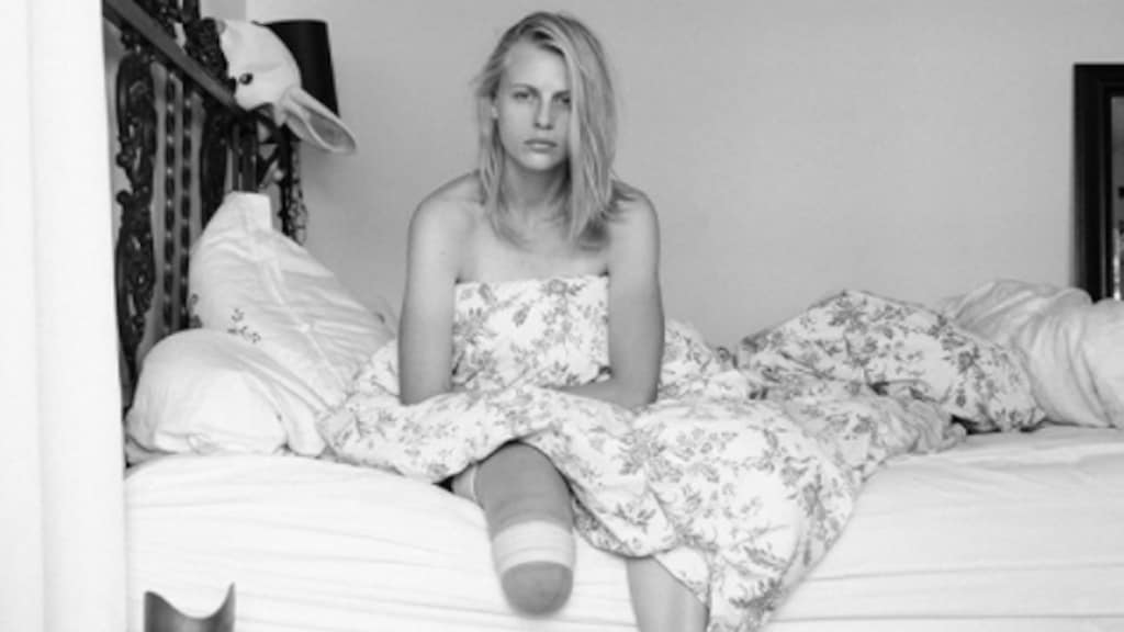 Amerikaans model raakt tweede been kwijt aan 'tamponziekte'