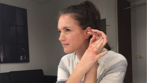 Marly van der Velden gaat met huidziekte de straat op