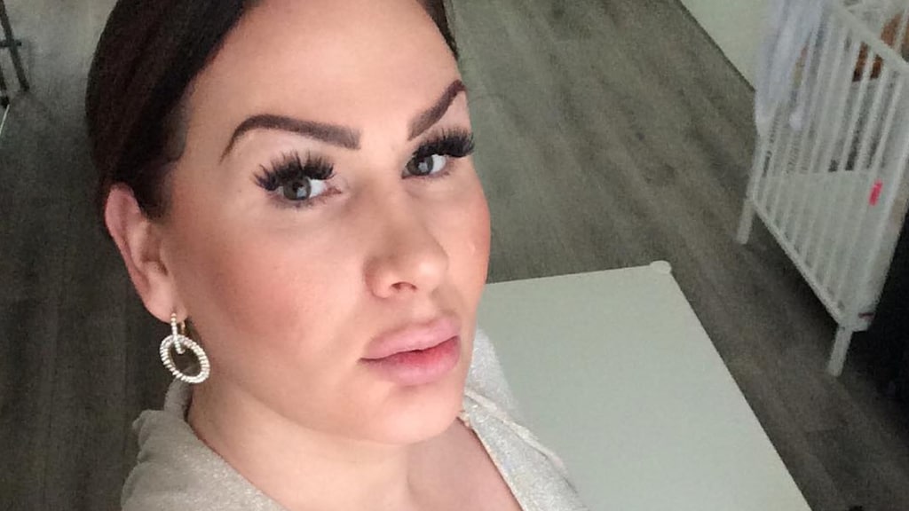 Louisa Janssen laat haar lipfillers verwijderen