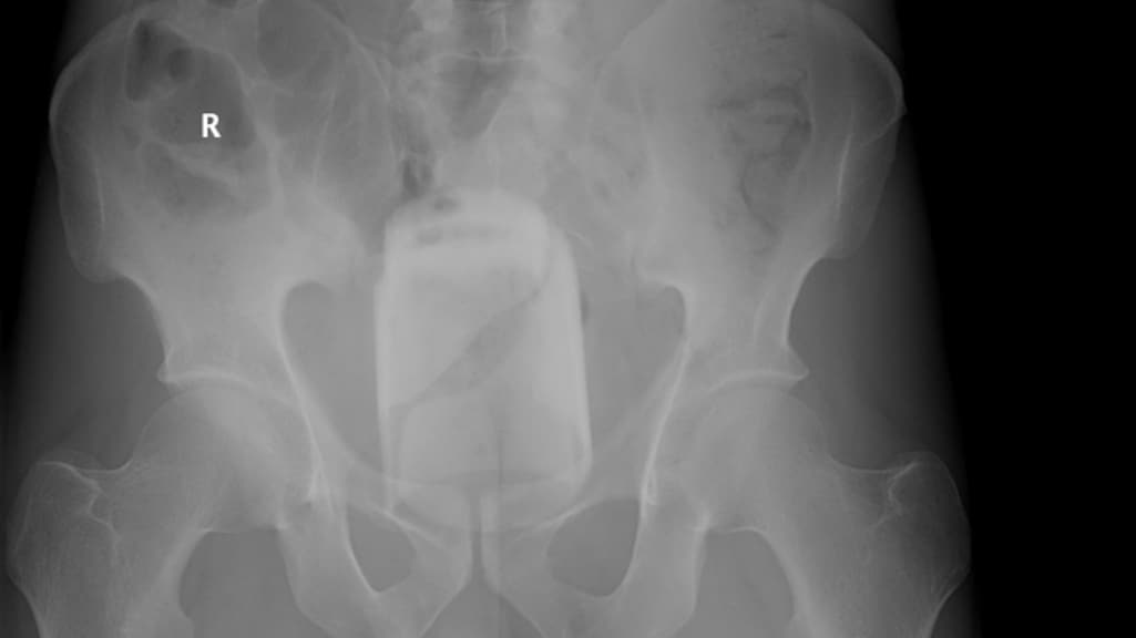 Een vastzittende glazen pot.