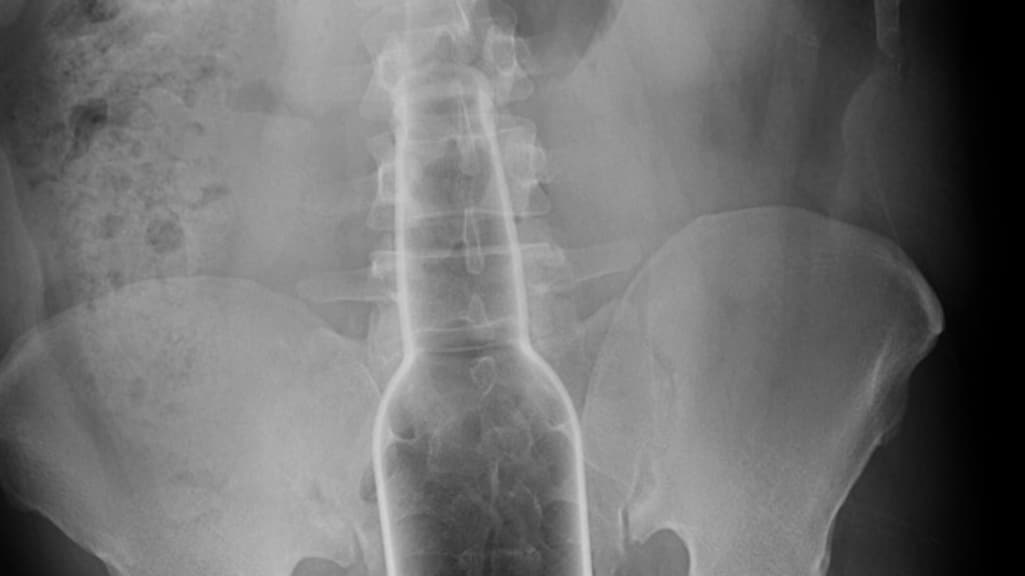 Een vastzittend bierflesje.