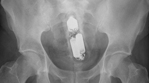 Meer ongelukken tussen de lakens: 'Je weet nooit of speeltjes veilig zijn'