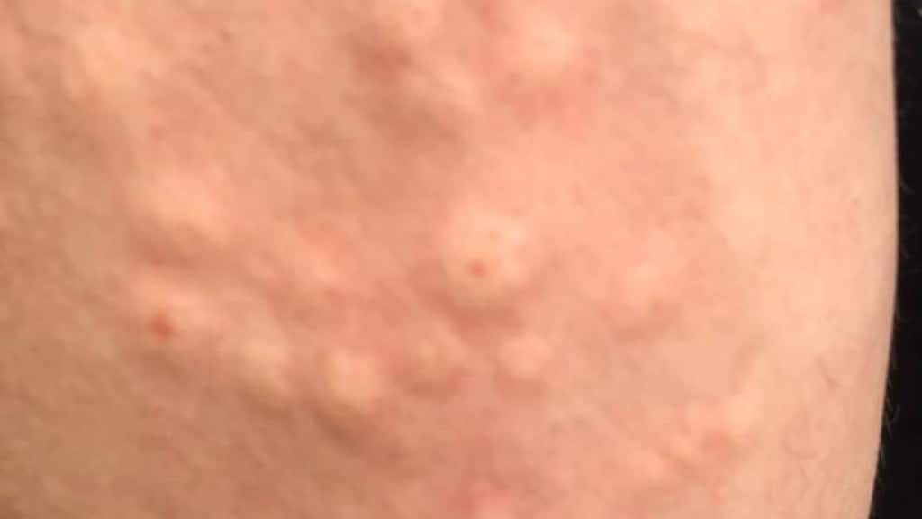 De bultjes zorgen voor veel jeuk.