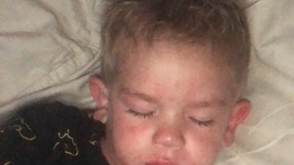 Jayden zit vol met de jeukende bultjes