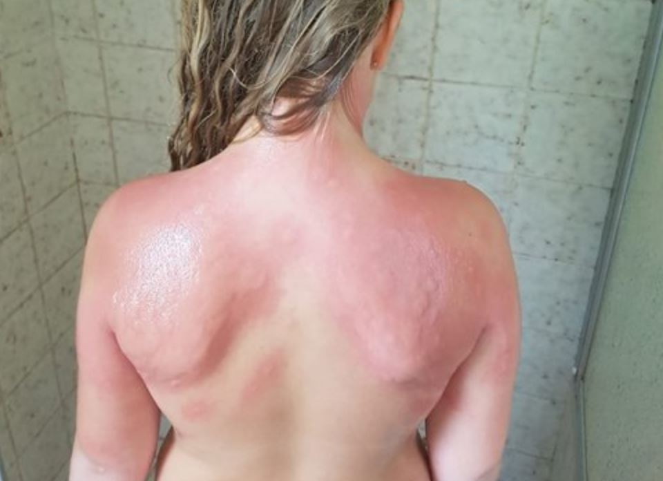 Explosieve stijging: duizenden mensen met jeuk naar huisarts, waarschijnlijk door eikenprocessierups