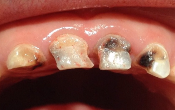 Een kindergebit in slechte staat