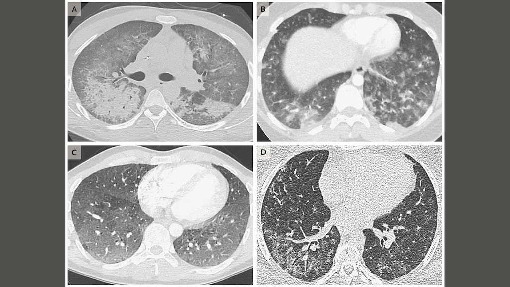 In het tijdschrift staan de röntgenfoto's van vier patiënten die schade hebben aan hun longen door het roken van een e-sigaret.