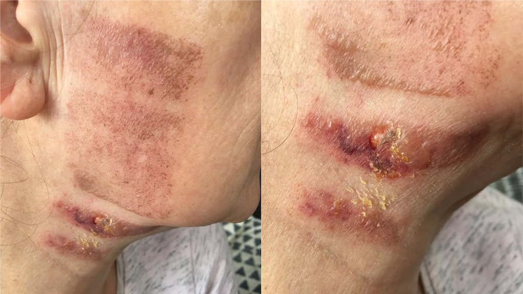 De brandwonden die Ingrid opliep.