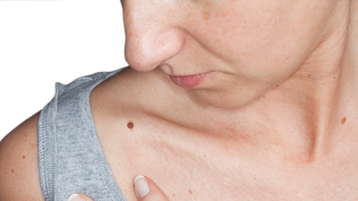 Rare plek? Zo herken je een kwaadaardige moedervlek