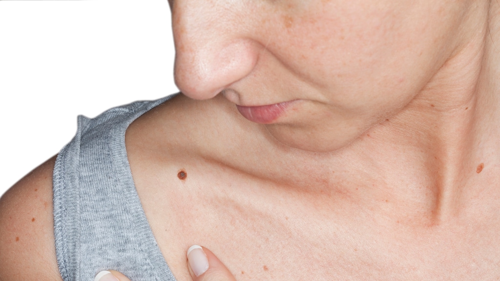 Rare plek? Zo herken je een kwaadaardige moedervlek