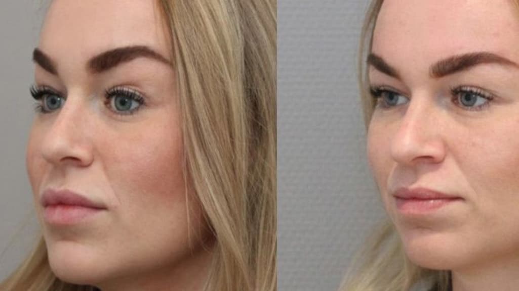 Links met fillers, rechts 2 weken na het verwijderen van de fillers