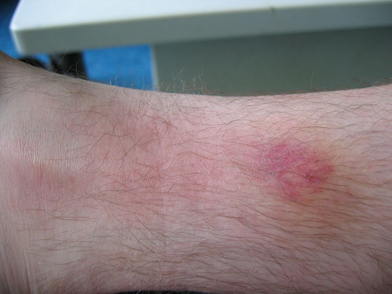 Gestoken door een steekvlieg? Dit moet je doen bij een dazenbeet