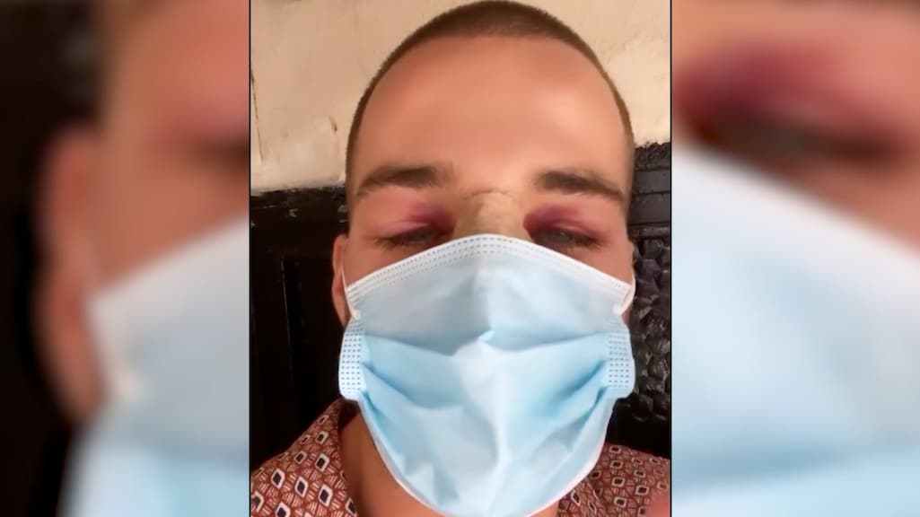 Donny Roelvink vertelt ware reden neusoperatie