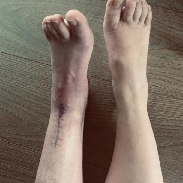 Dianne werd in totaal 15 keer geopereerd.