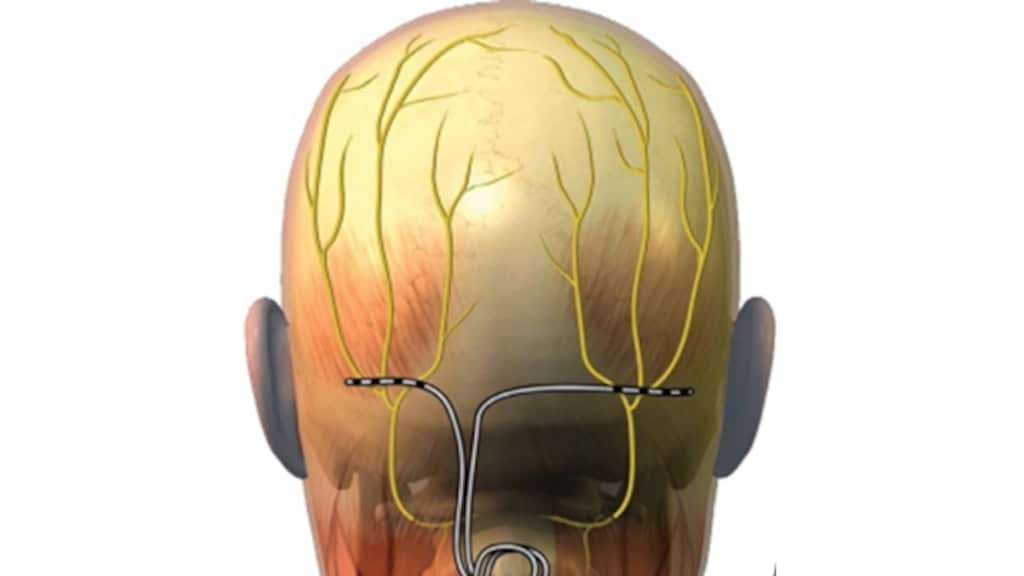 De neurostimulator zit onderhuids op het achterhoofd. In de buik of bil zit een batterij die met een draad verbonden is met de stimulator en het voorziet van stroom.
