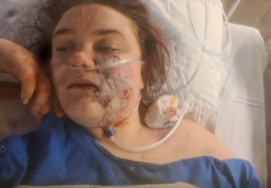 Julia gebeten door pitbull: 'M'n gezicht was helemaal verbrijzeld'