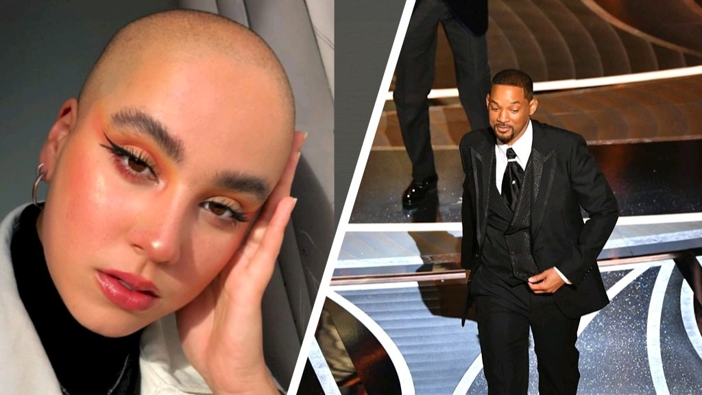 De klap van Will Smith na grap over alopecia 'laat frustratie van patiënten zien'