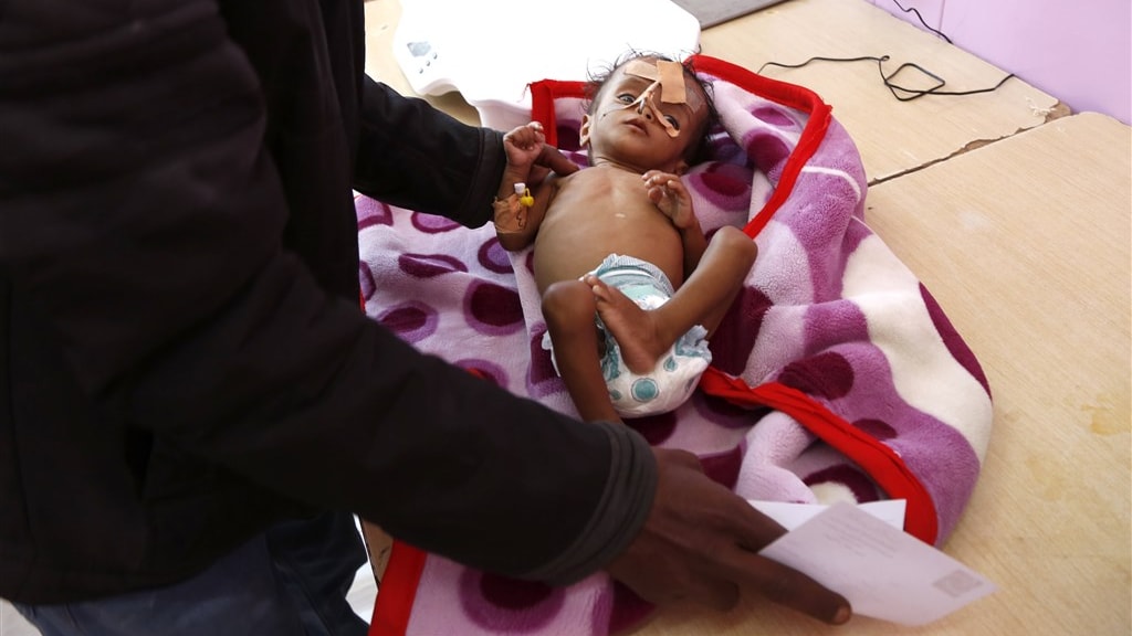 Een ondervoed kindje in een ziekenhuis in Sanaa, Jemen. Volgens een lokale Unicef-missie krijgen 400 duizend kinderen er nu te maken met ernstige acute ondervoeding.