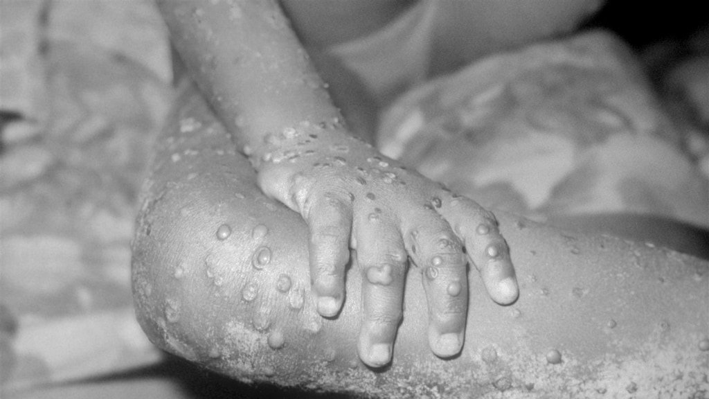 Tweede geval met apenpokken in België, ook besmettingen in Duitsland en Frankrijk