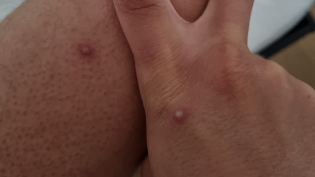 Tim had als één van de eersten apenpokken: 'Dacht dat het muggenbulten waren'