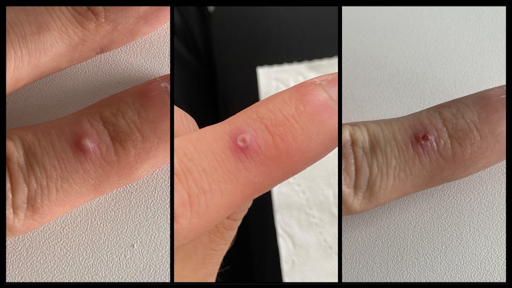 Apenpokken, vanaf links: fase 1, fase 2 en fase 3.