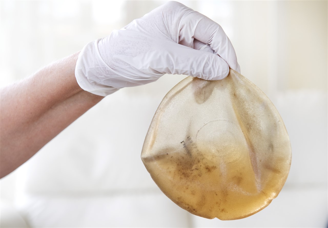 Onderzoek: nieuwe vormen van kanker bij vrouwen met borstimplantaten