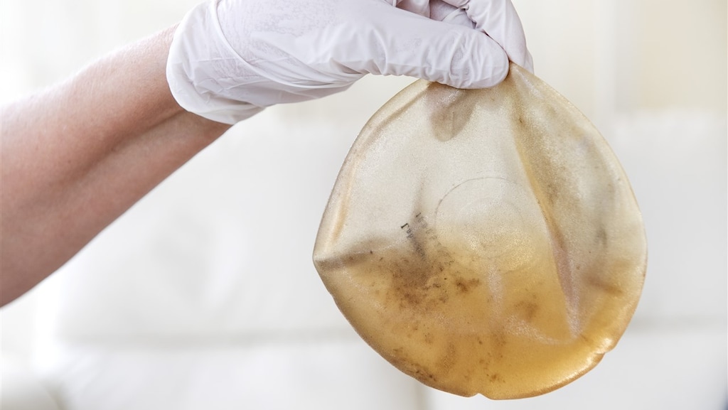 Onderzoek: nieuwe vormen van kanker bij vrouwen met borstimplantaten