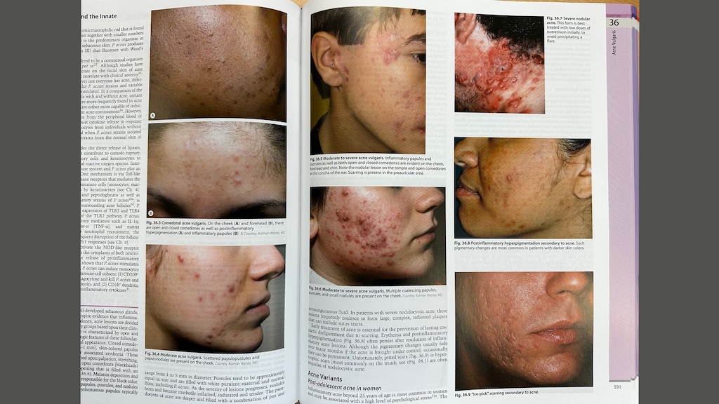 Foto's in handboek dermatologen - Dermatology van Bolognia