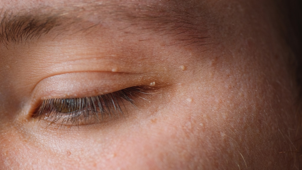 Angie: 'Hoe kom ik van de gerstekorrels in mijn gezicht af?'
