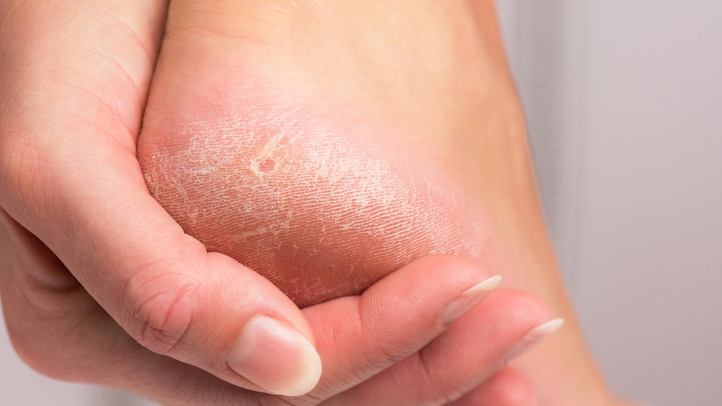 Lotte: 'Ik schaam me voor mijn eeltige voeten'