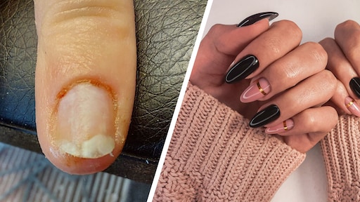Experts waarschuwen voor kunstnagels: van jeuk tot brandwonden