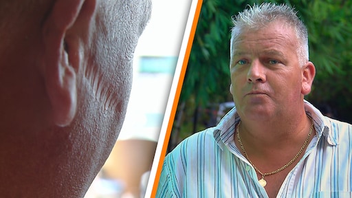 Martijn uit B&B Vol Liefde openhartig over litteken in gezicht: 'Niet iets om trots op te zijn'
