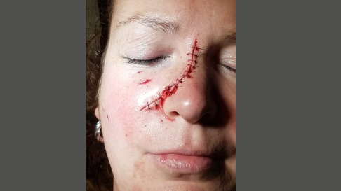 Rottweiler beet Chantal in gezicht: 'Als ik geblaf hoor, lopen rillingen over rug'