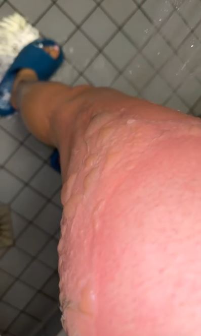 Het been van Sandy, vol met blaren.