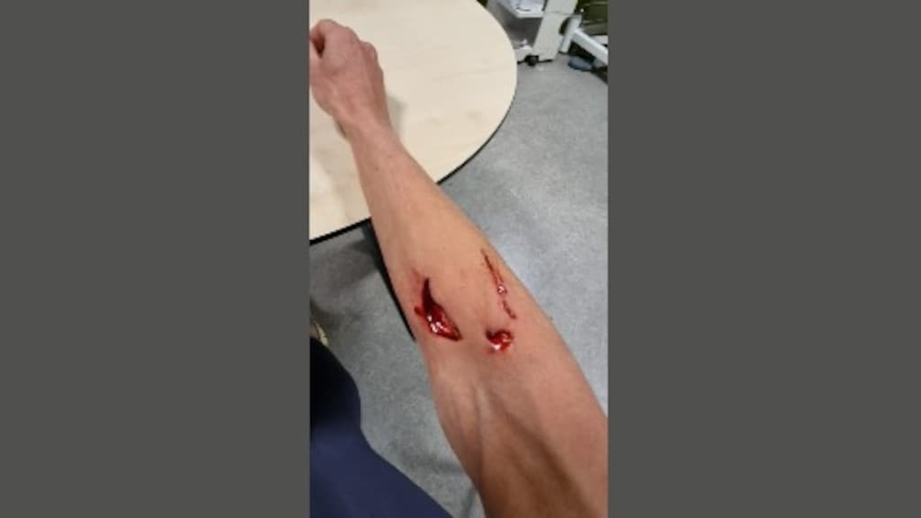 De hondenbeet in Rosanne's arm