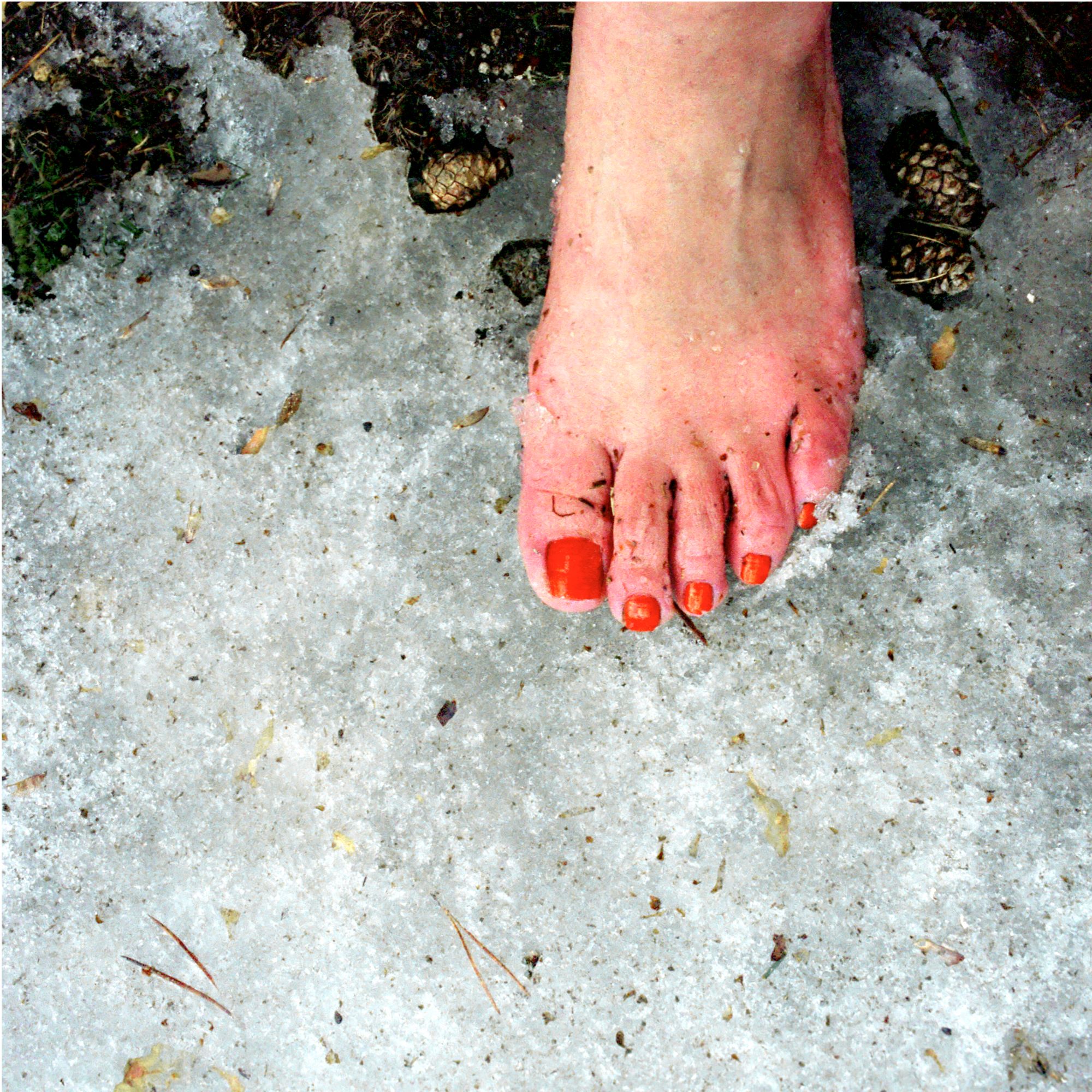 Nadja heeft last van wintertenen: 'Jeuk is bijna ondraaglijk'