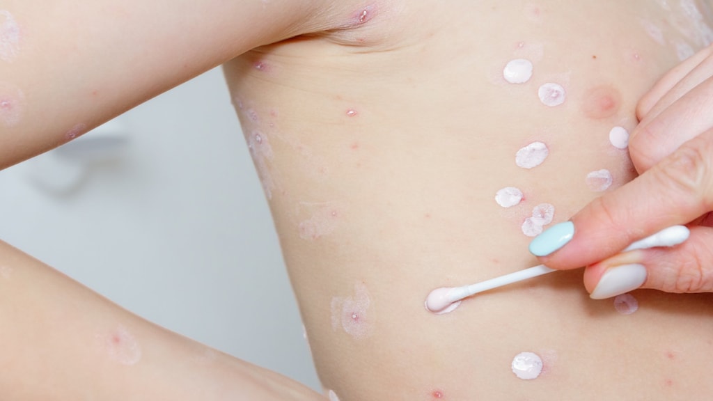 Zorgen om mogelijke mazelenuitbraak: 'Gevaar voor baby's'