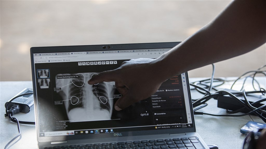 Meer gevallen van tbc nu coronapandemie voorbij is