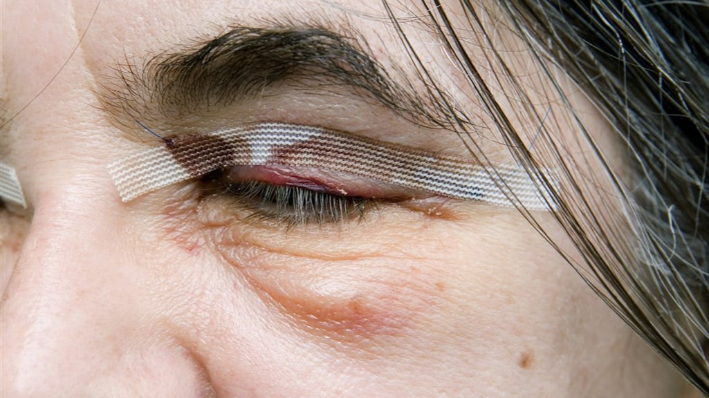 Een geslaagde ooglidcorrectie, ter illustratie.