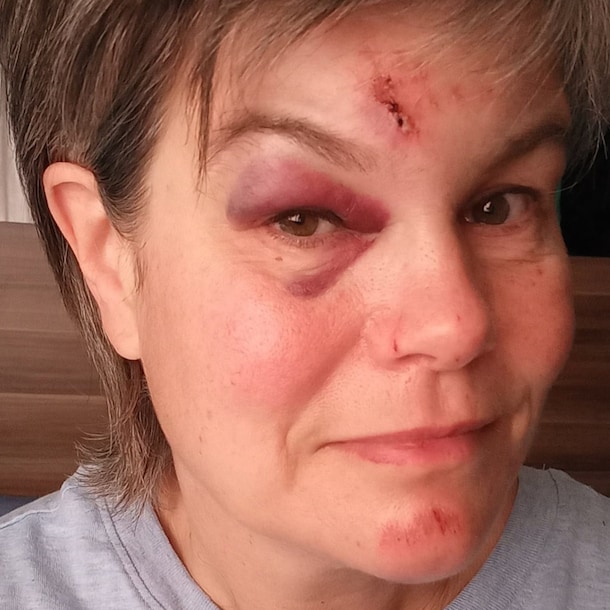 Edith heeft veel last van haar val.