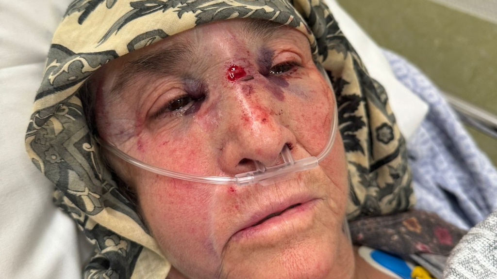 Foto van de verwondingen van het gezicht van Cemile Telli